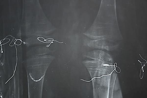 Líneas de Harris en epífisis distal de fémures y epífisis proximal de tibias (momia 1)