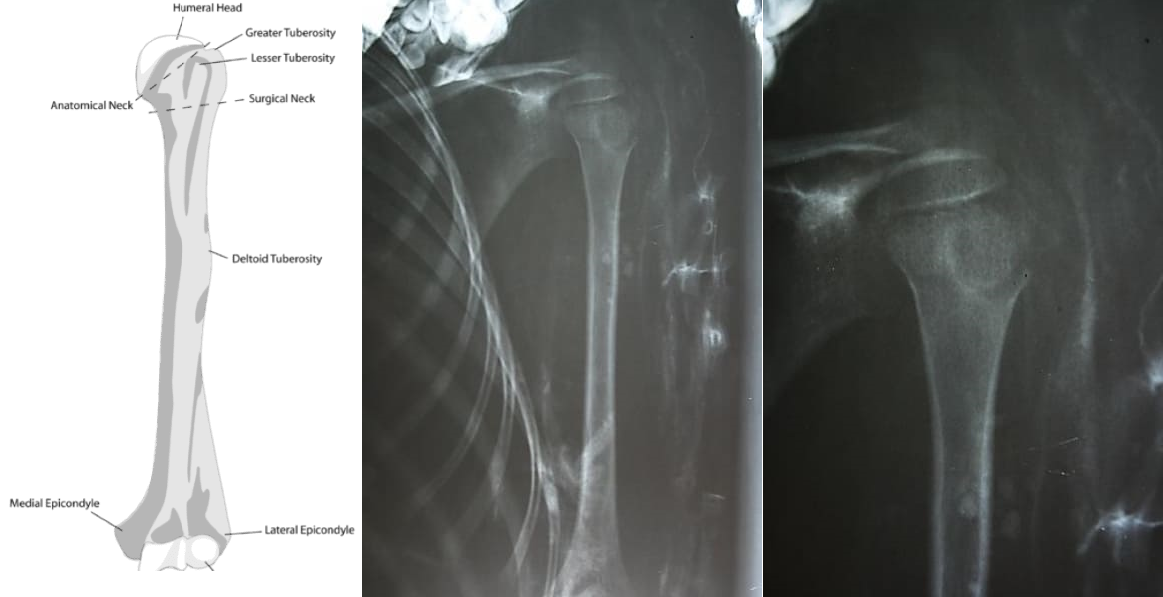 Momia 2. Fractura de troquíter en epífisis proximal de húmero izquierdo.